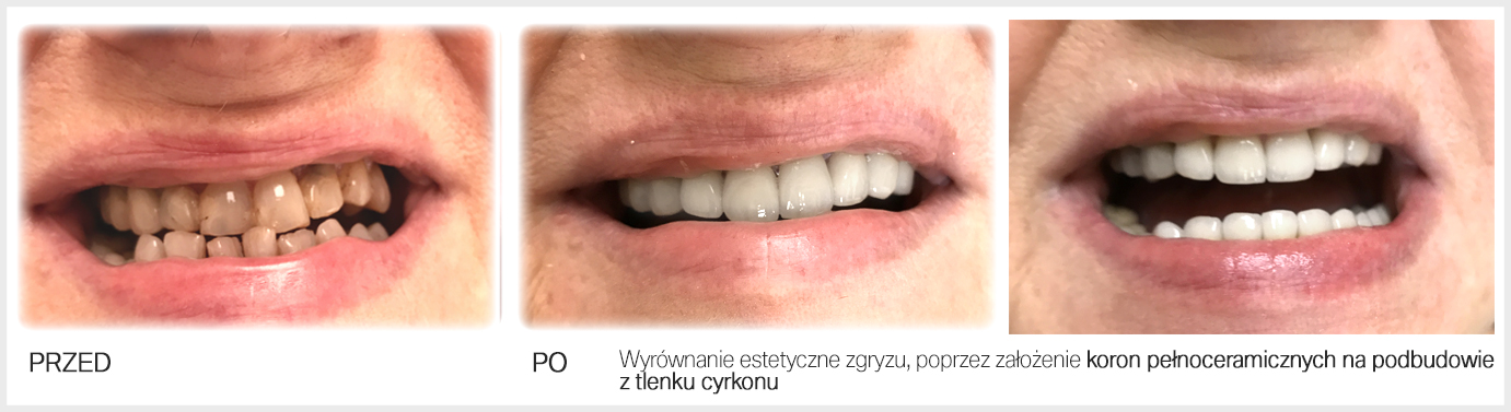 Całkowity koszt implantu zęba