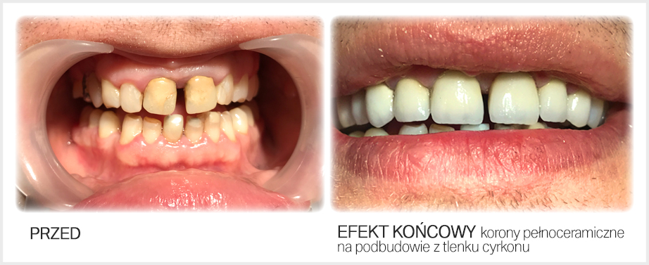 Korony pełnoceramiczne na implantach