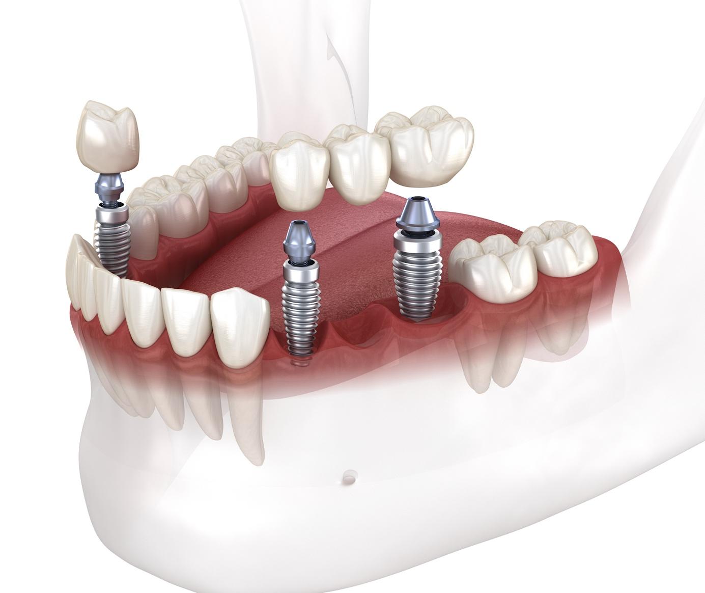 Korony i mosty na implantach