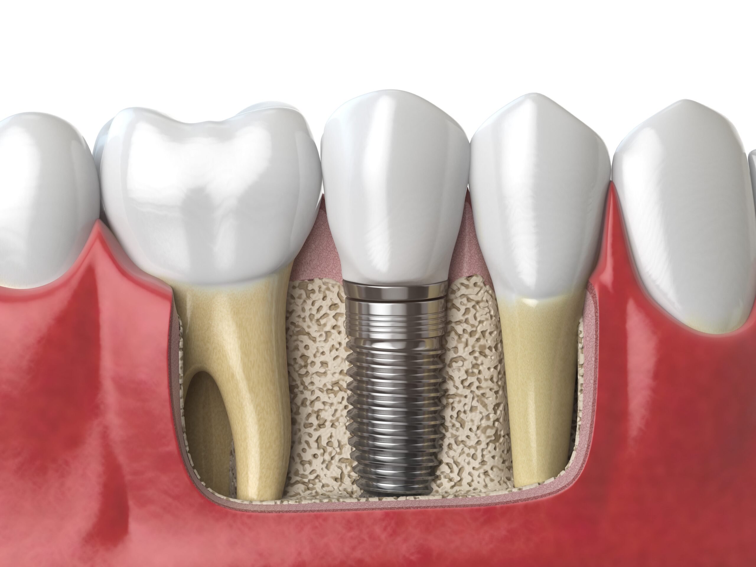 Implantacja natychmiastowa