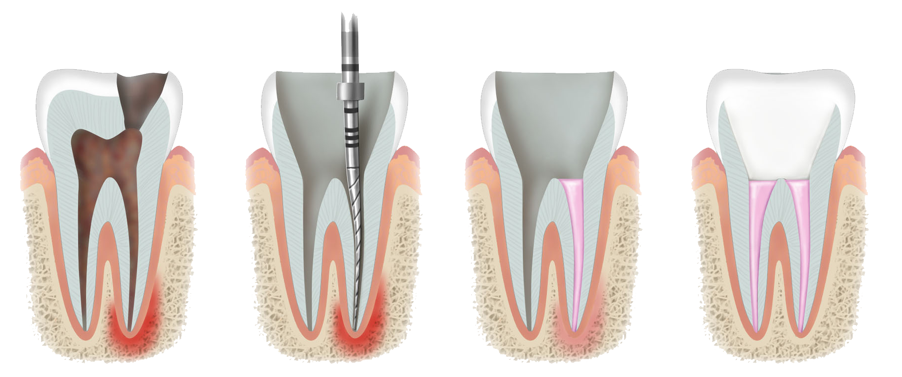 Leczenie endodontyczne - endodoncja