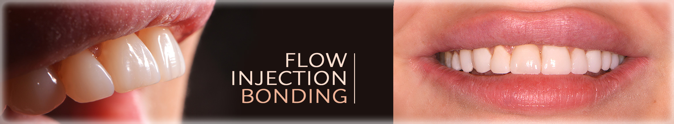 Flow injection - korekta kształtu zębów