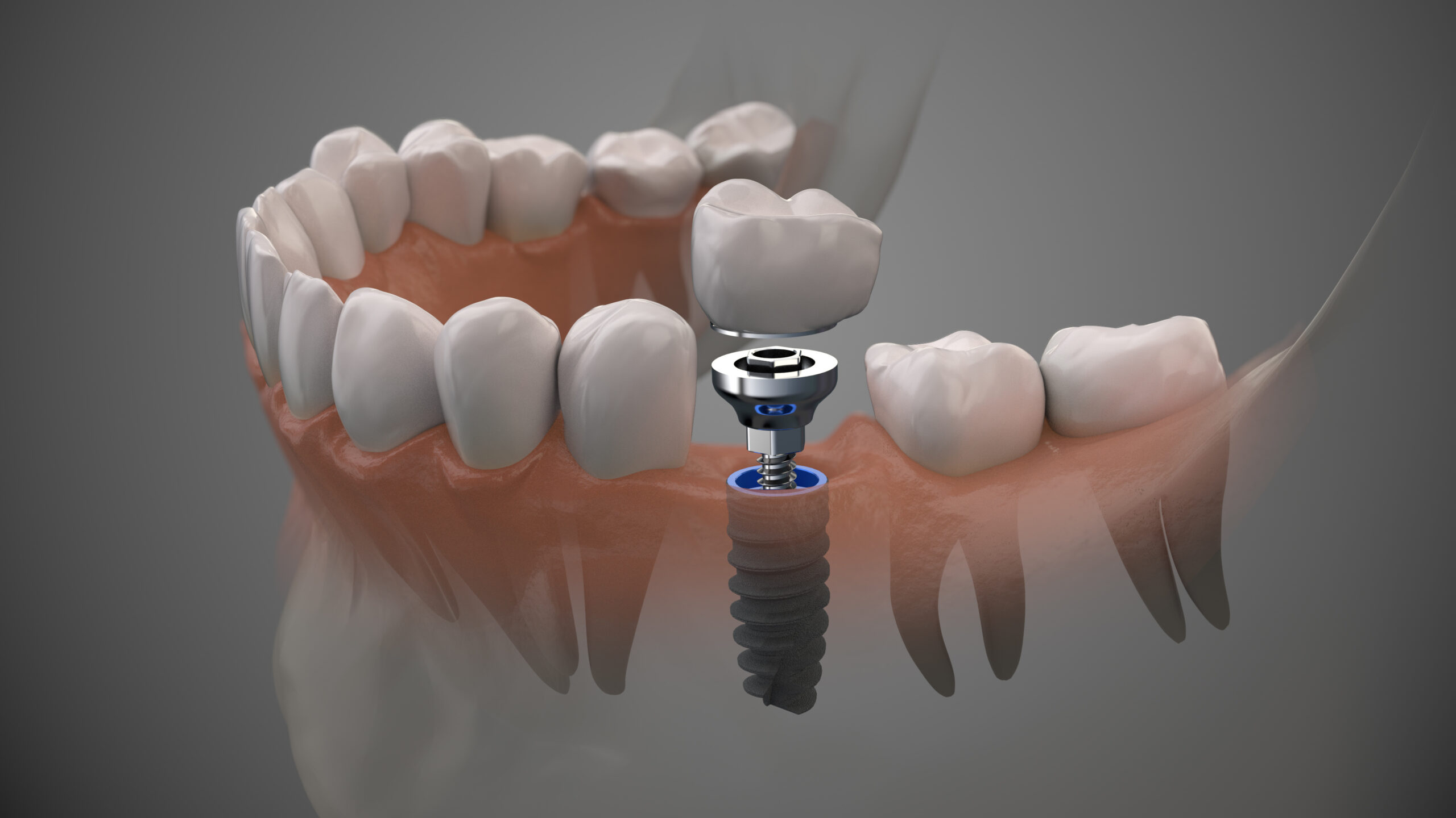 Implantacja jedno- i dwuetapowa